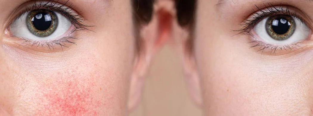 Tratamente Laser în Dermatologie Medicală