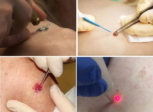 Intervenții Dermatologice Minore