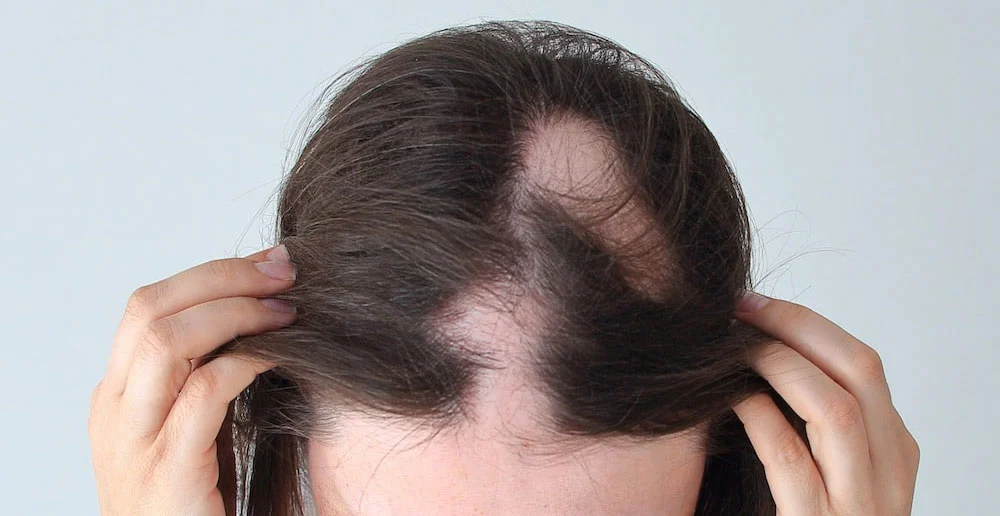 Alopecii Afecțiuni Ale Scalpului