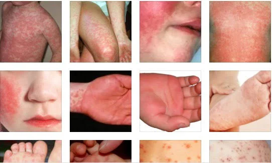 Infecții Cutanate & Afecțiuni Virale / Fungice